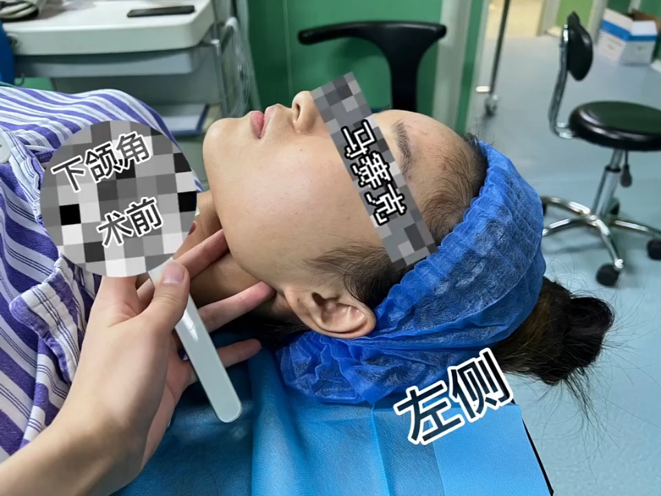 下颌角磨骨 // 面部轮廓是地基 眉眼鼻 配图1