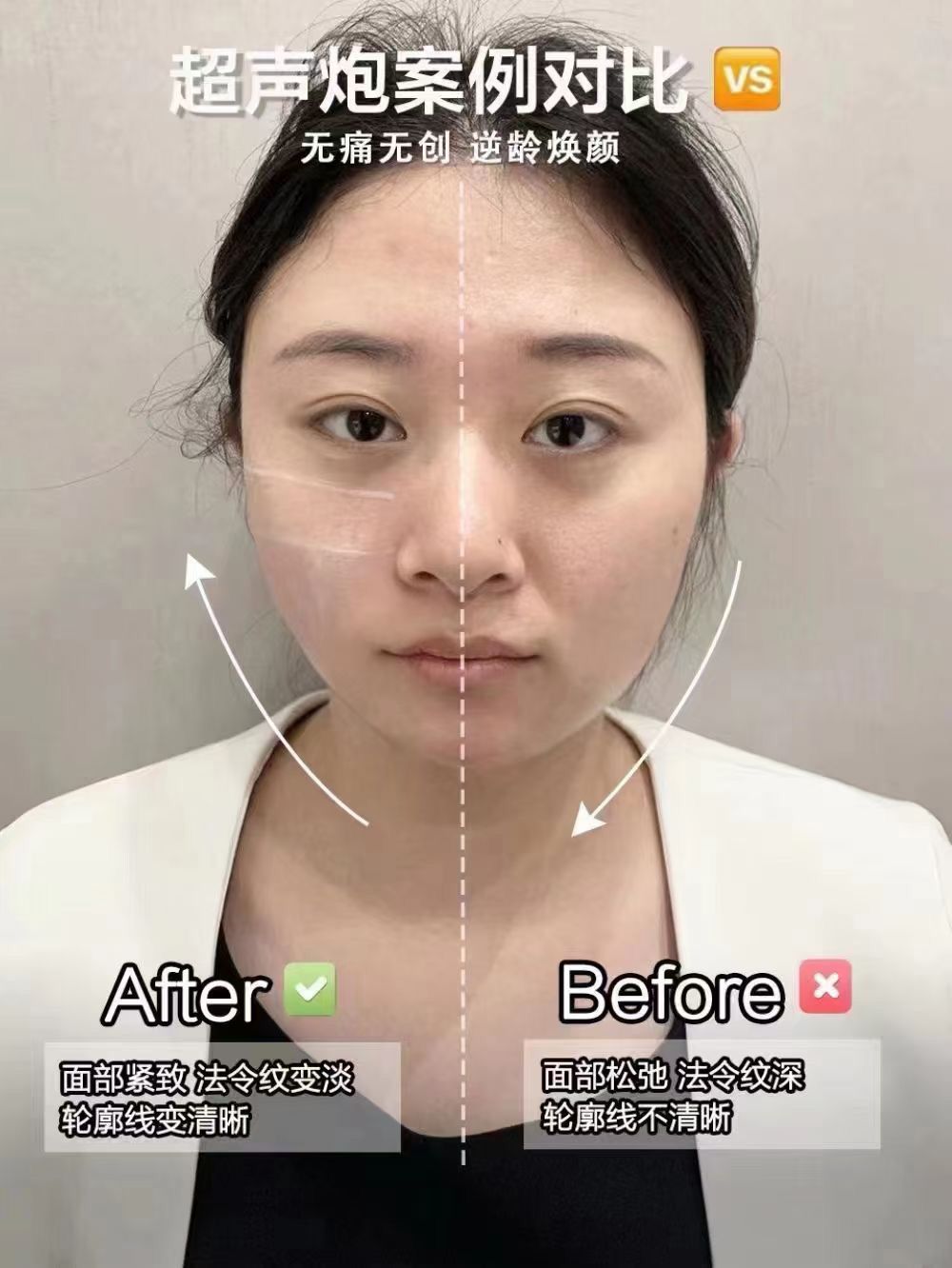 黄金超声炮‼️ 松、垂、法令纹克星😉 没