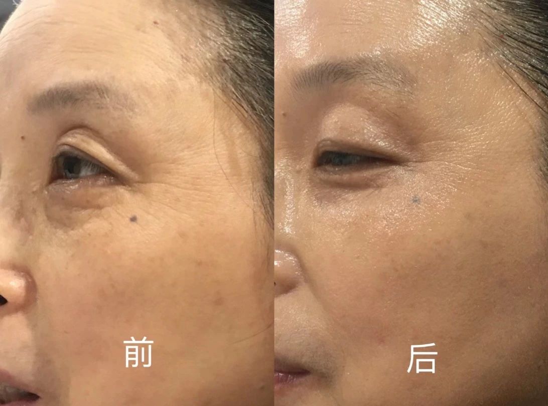 你脸上的第一道细纹 一定是沿着眼角悄悄爬