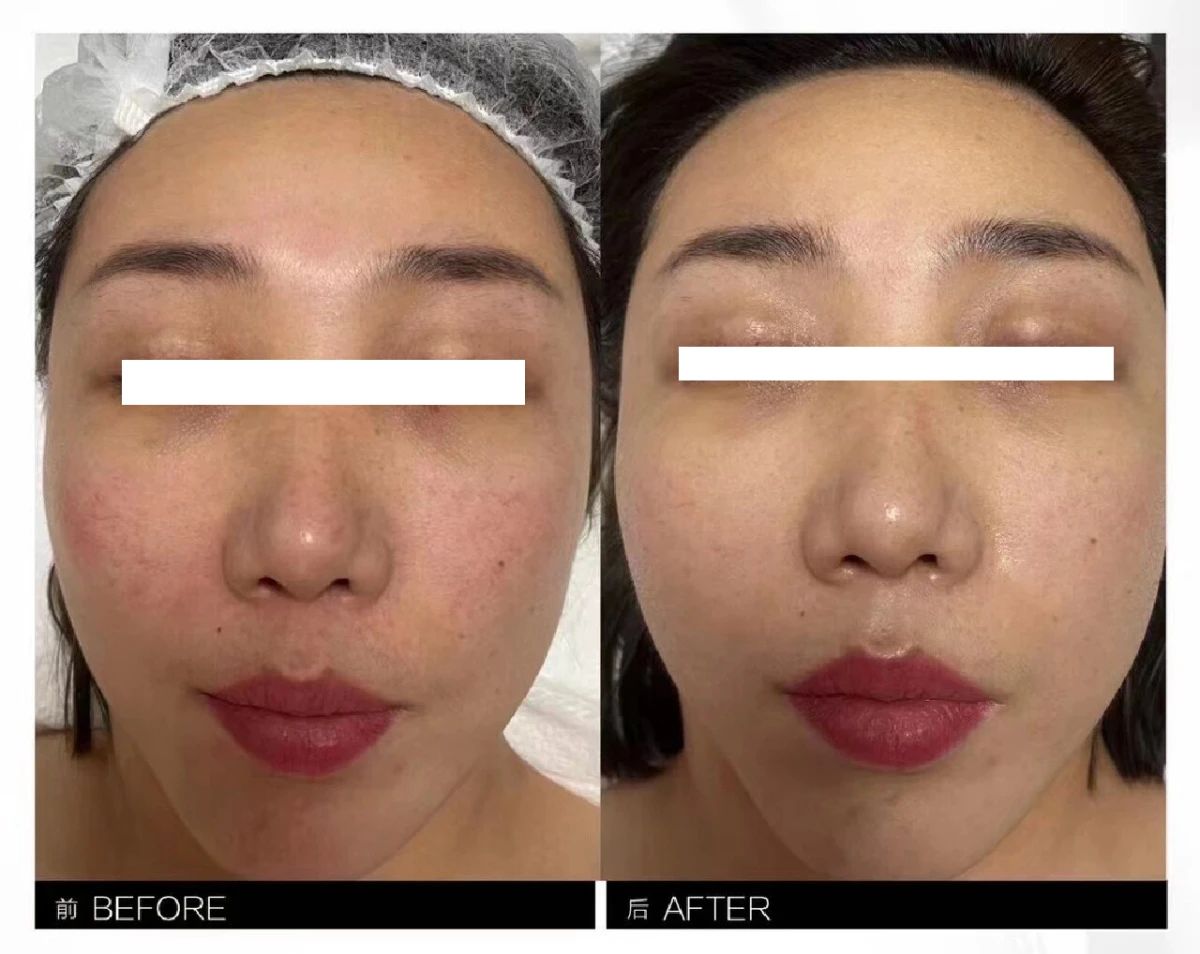 水光针真的值得尝试 唤醒肌肤新生的秘密 