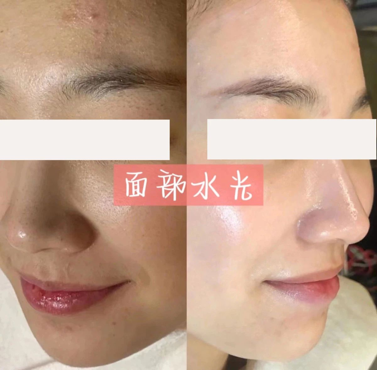 夏秋换季简直是干皮的灾难 水光针，深层有