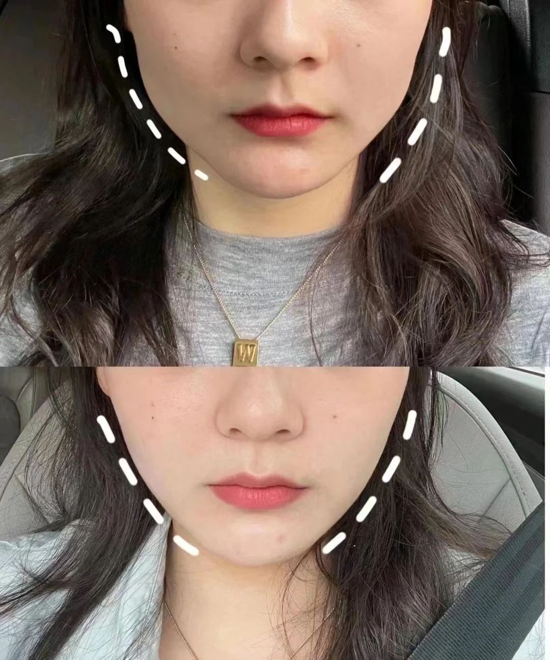 瘦脸针前后对比🆚 知道大饼脸给你带来 多