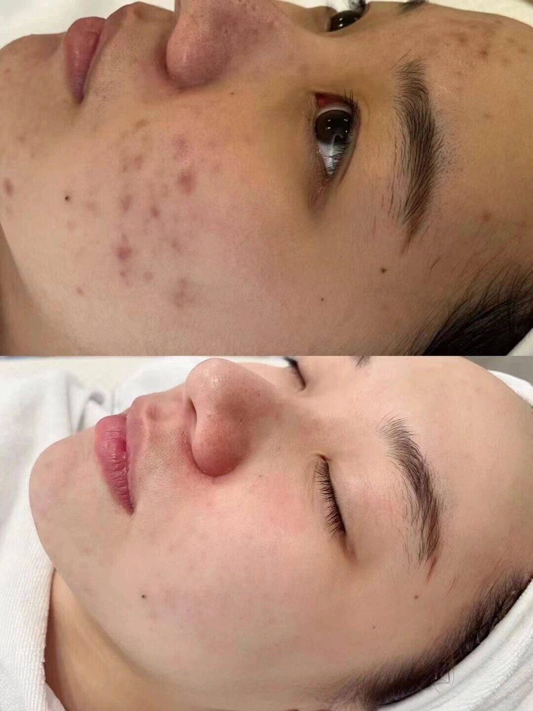 痘痘肌交作业啦 小姐姐做完了4次管理的对