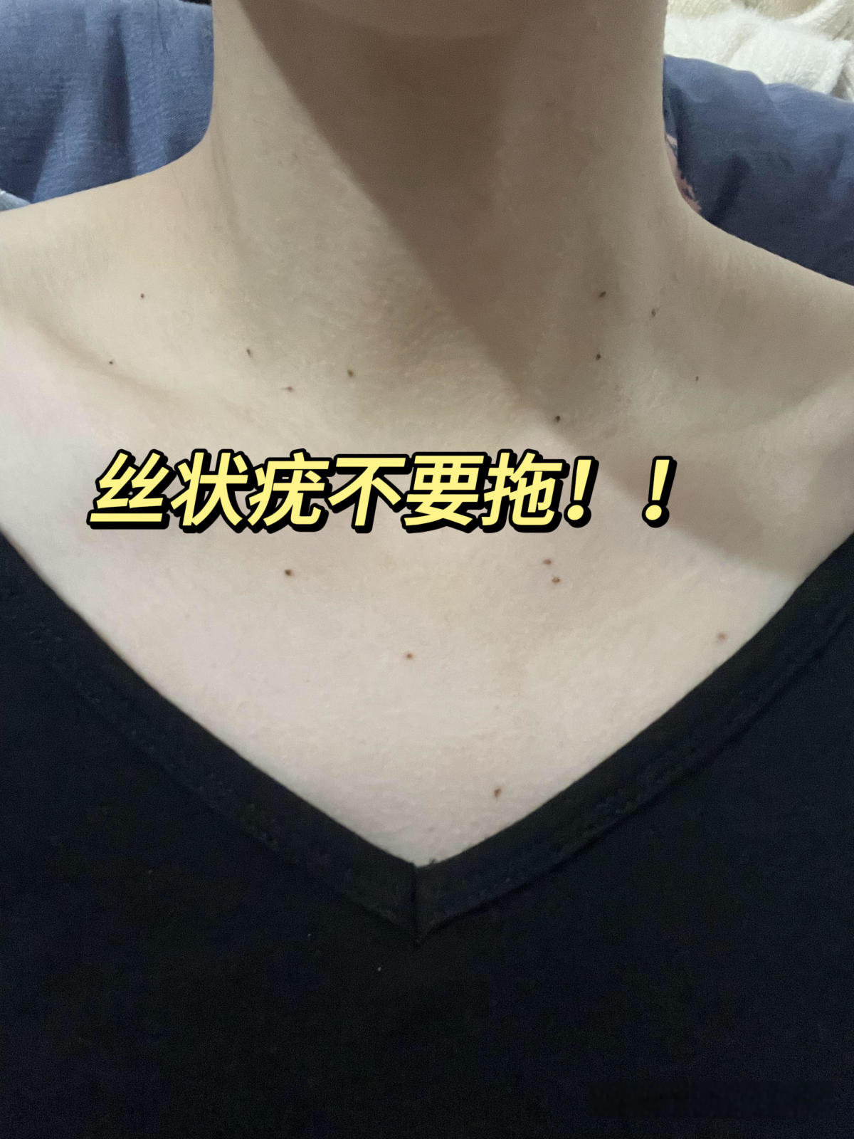 老客户转介绍·祛疣 疣不祛除，会一生二，