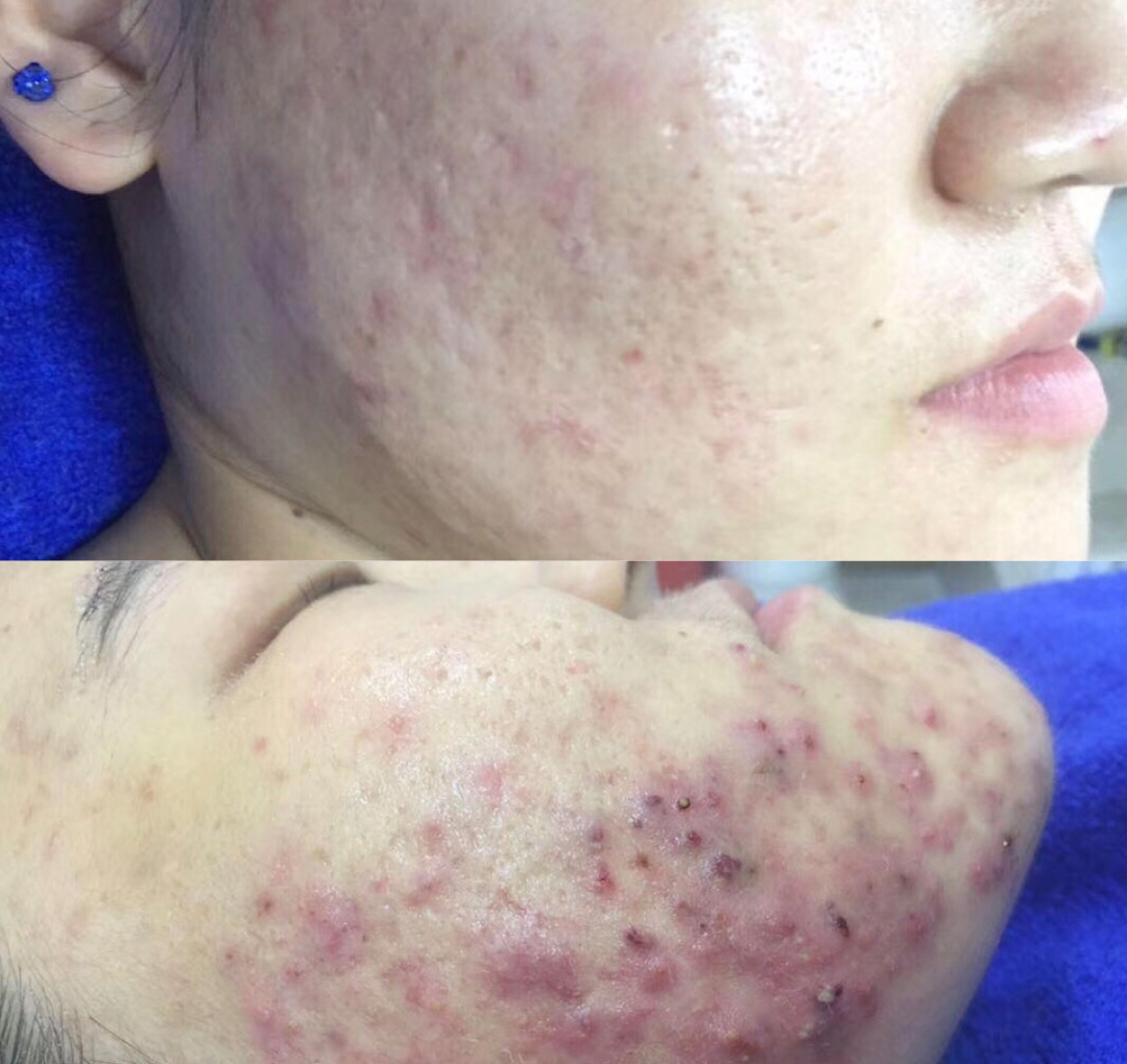 放任痘痘脸，越来越难看 从小小一个变成囊