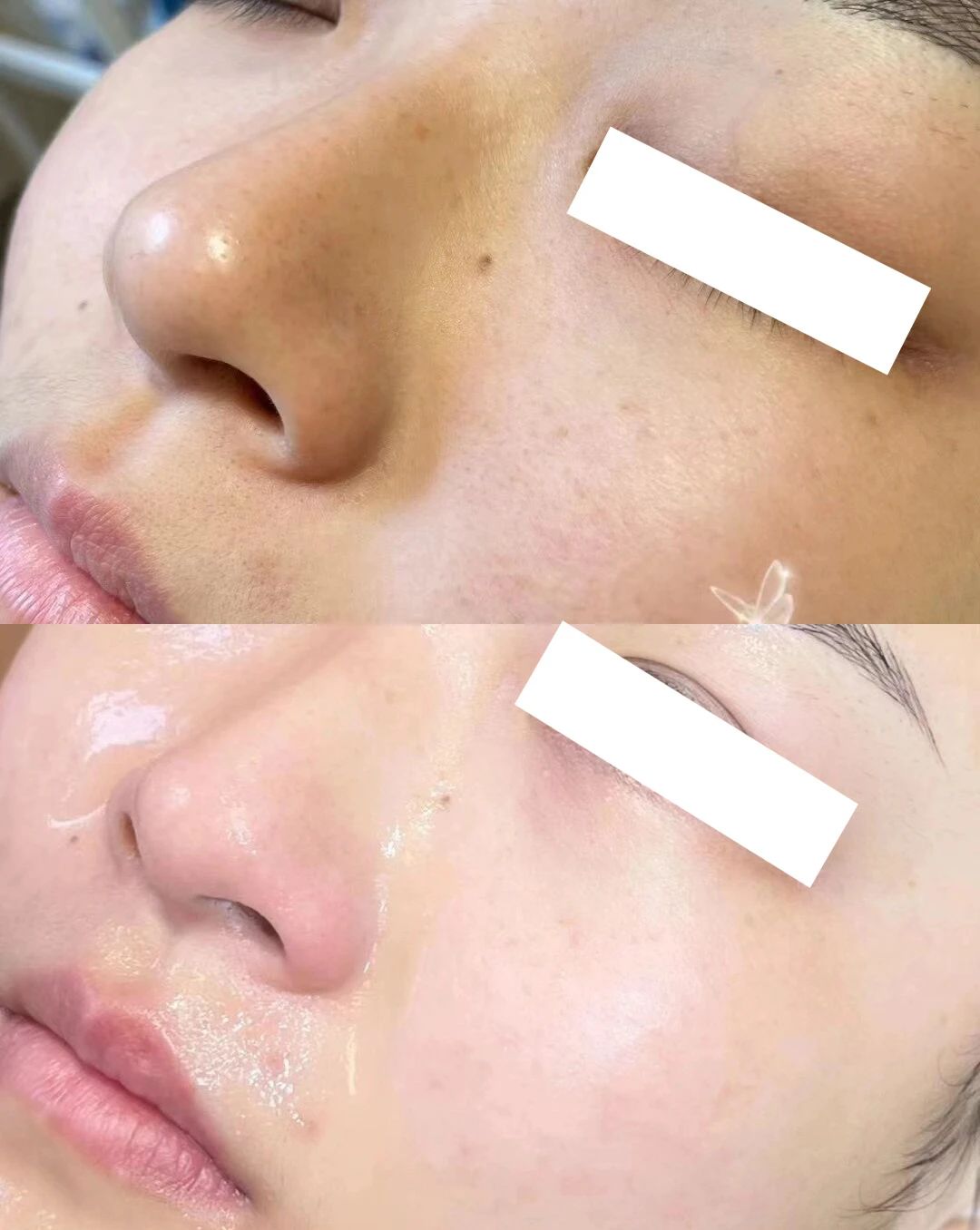贵妇保养☞水光针💦 姐妹们千万不要轻易做