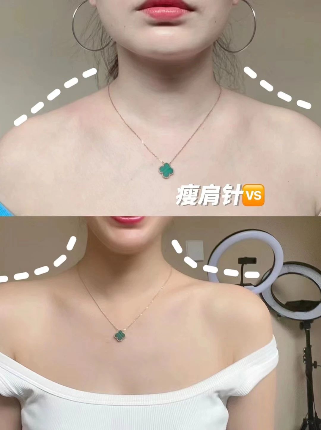 你不试一次瘦肩针 怎么知道好不好 不光是
