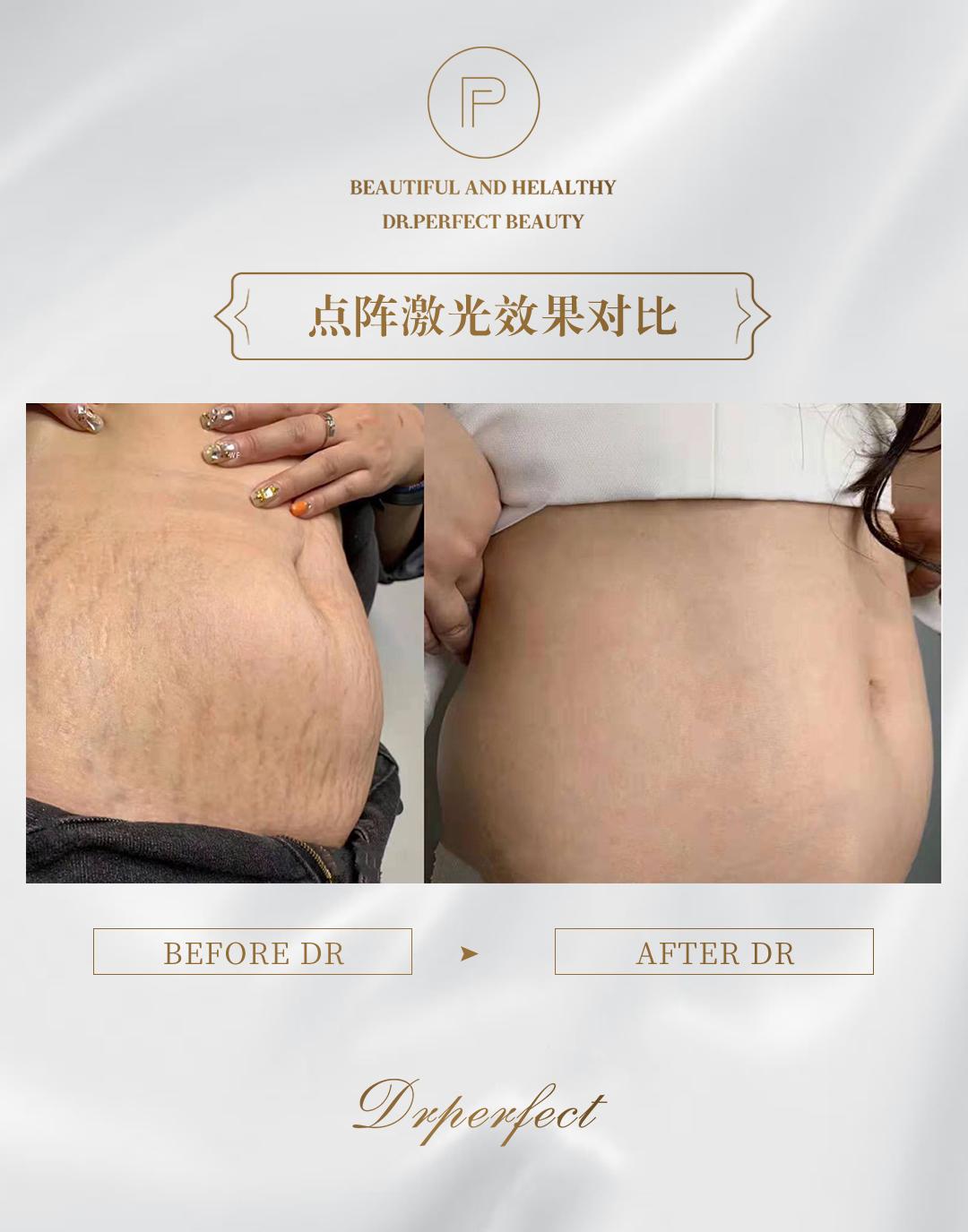 📸 妊娠纹点阵激光效果对比