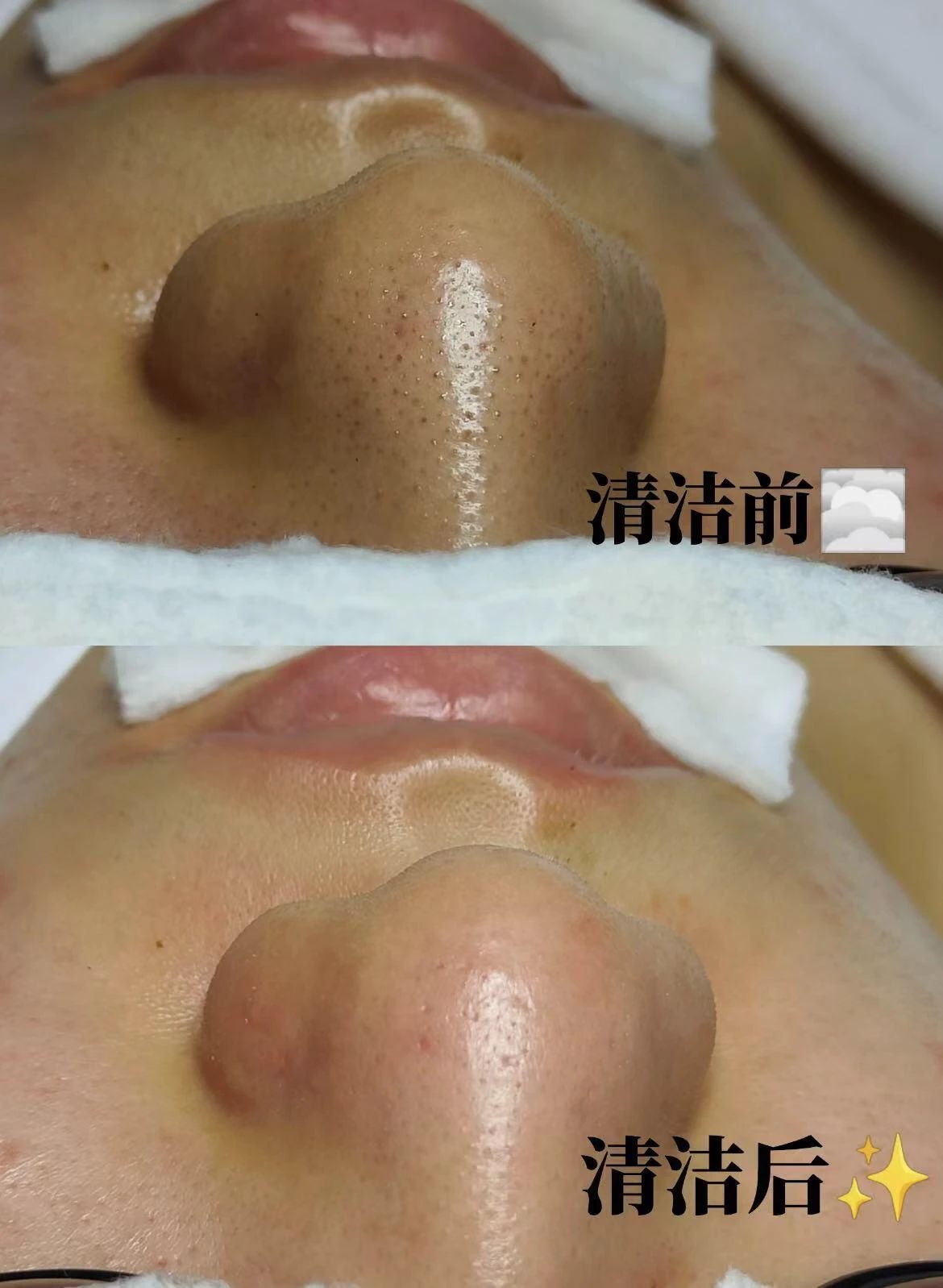 毛囊清洁🔔 简单的事情重复做 只有扫除皮