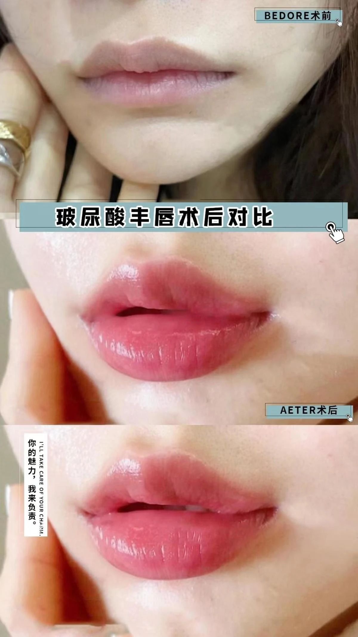【玻尿酸·丰唇】 无恢复期，随做随走 嘴
