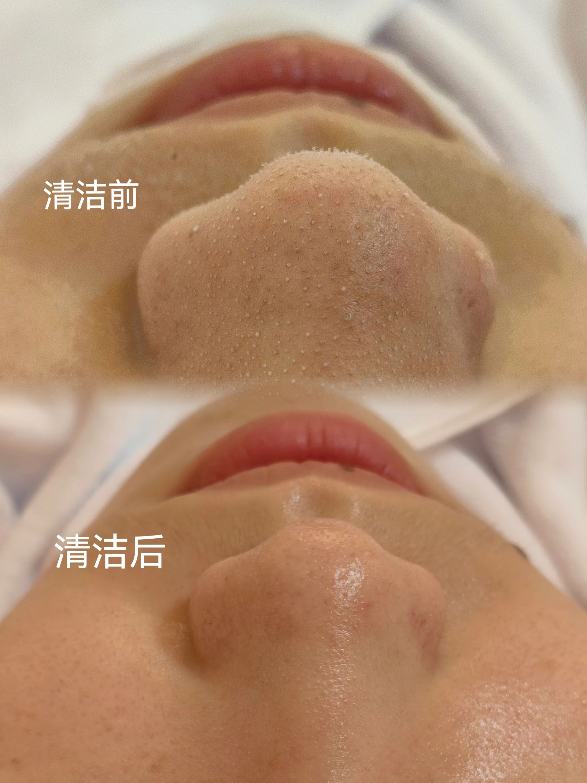 毛囊清洁 今日小姐妹都问，为什么我敷面膜