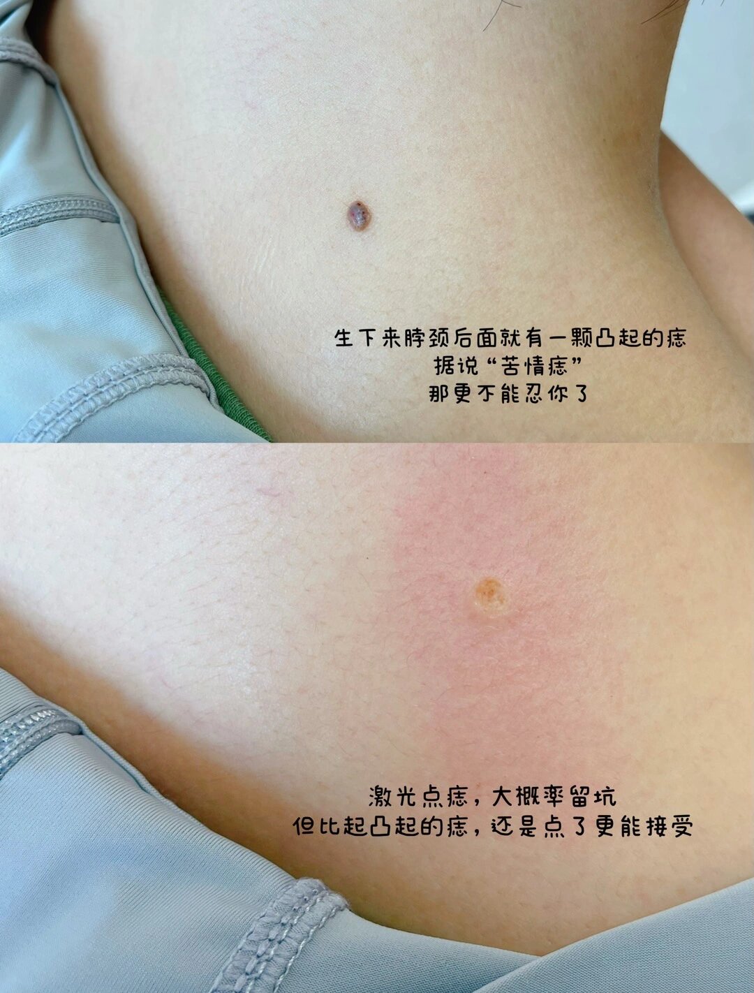 面诊说脖子上这颗痣是安全的痣 如果坚持点