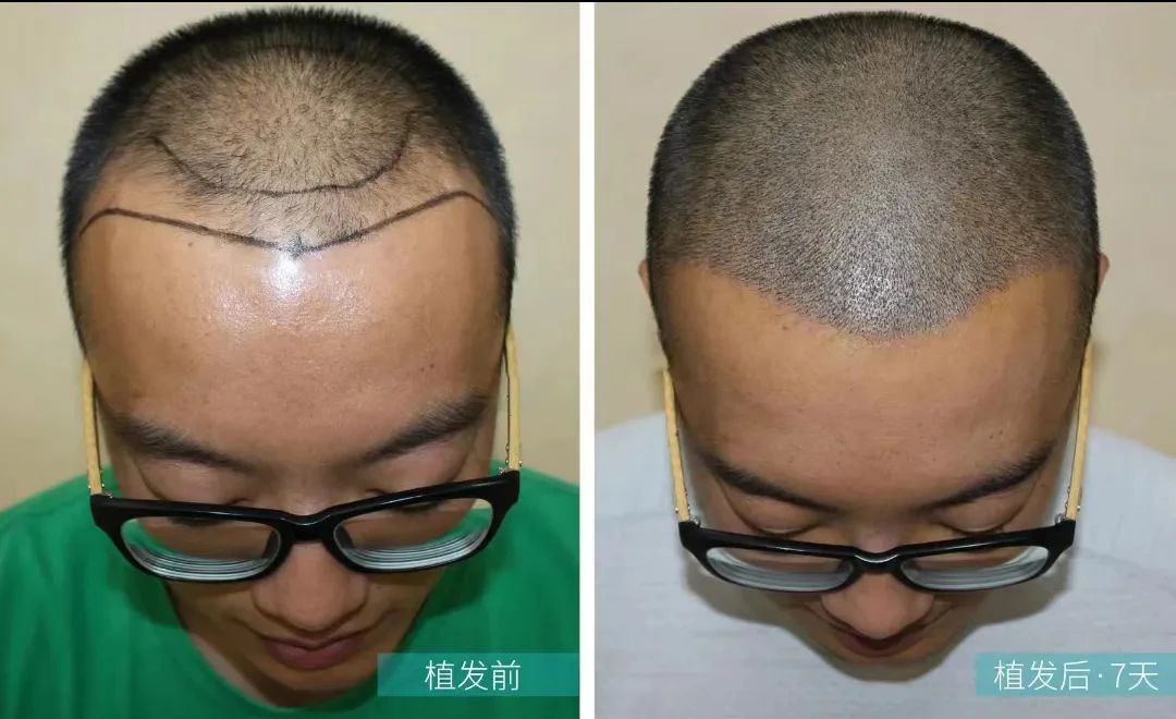 男士植发🎈 从头皮清晰可见到根根发丝重现
