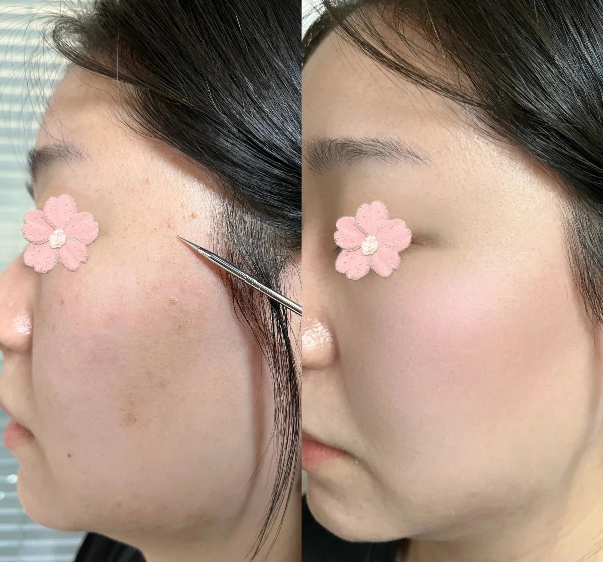 面部长扁平疣是凸起的 用手摸会有颗粒感 