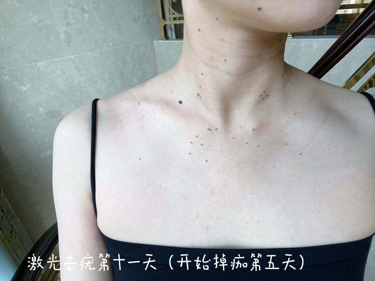 别再盲目祛疣❌ 选择专业级皮肤管理✅ 祛