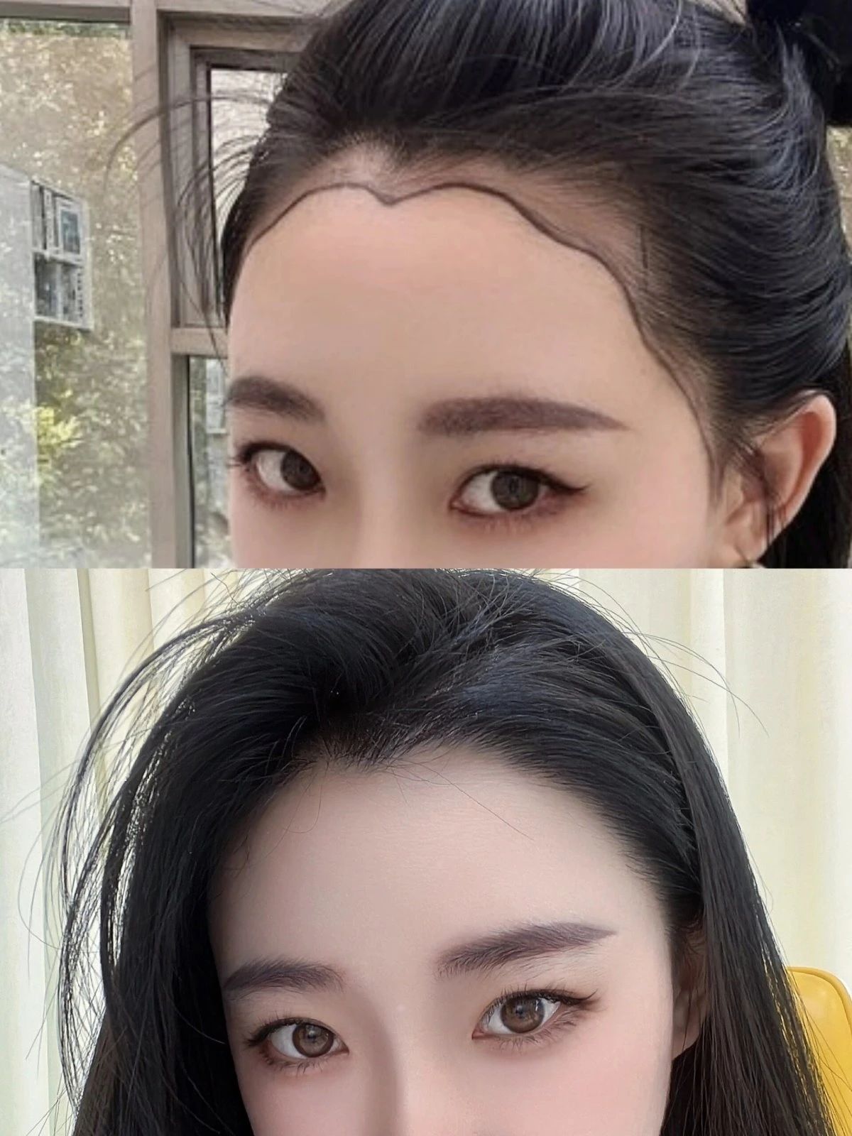 我觉得植发这件事很值 变年轻了 而且做各