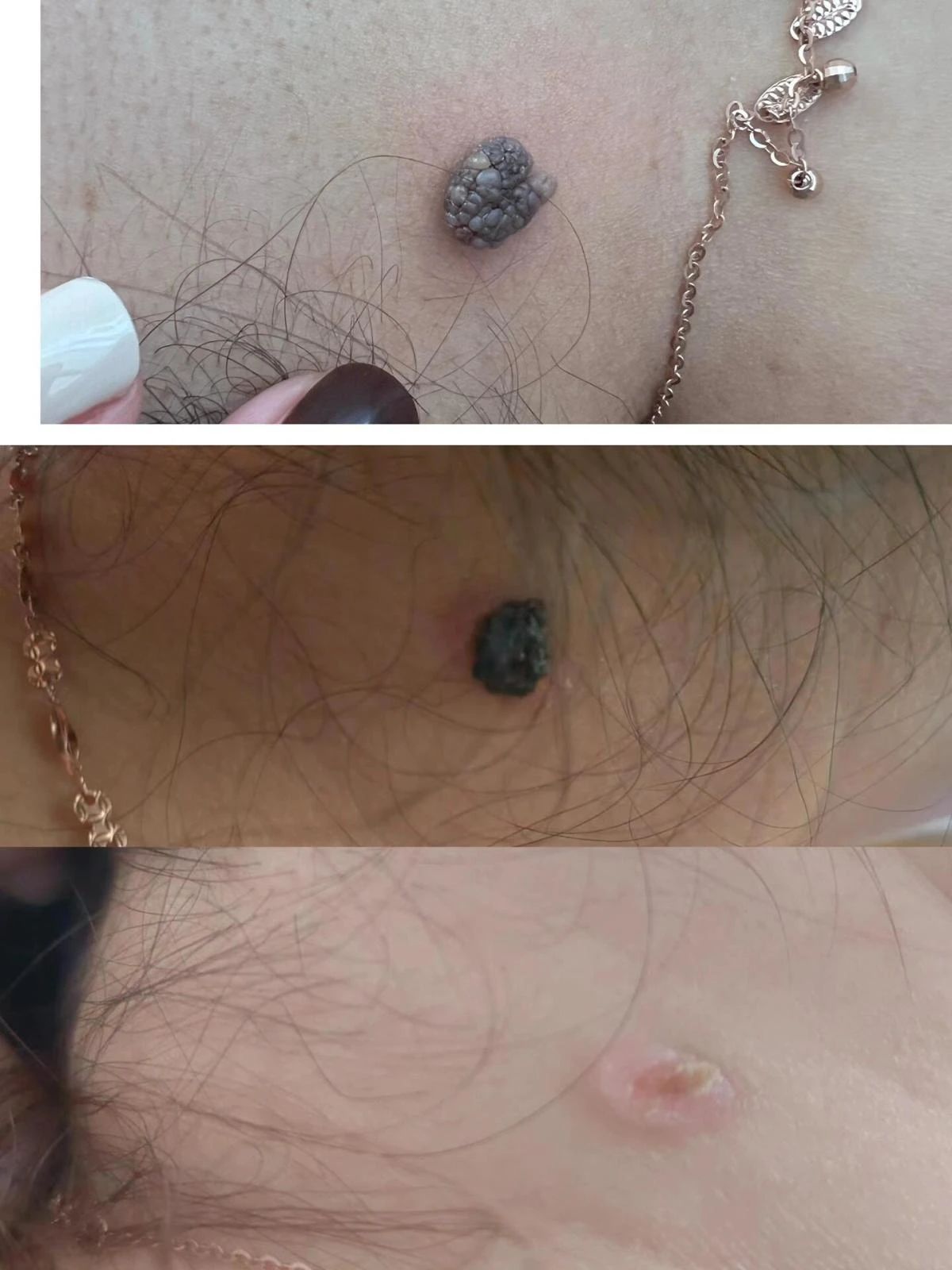 肌肤的舒畅，源于心灵的宁静 去掉肉痣的烦