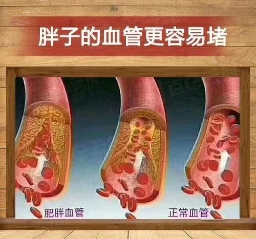 为什么要减肥⁉️看看血管就明白了👇 ✔️