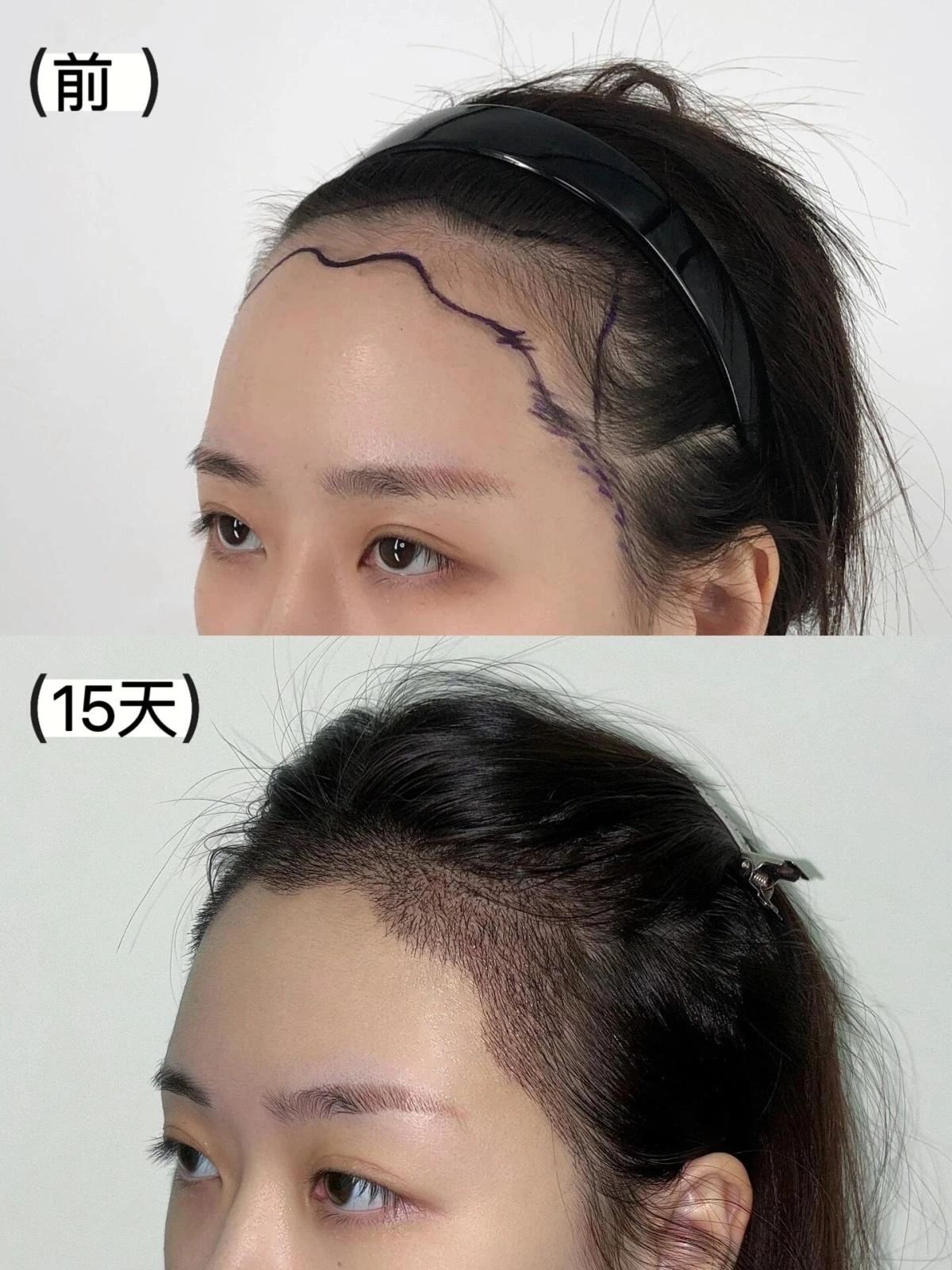 秃头大脑门 发际线后移都可以拯救 想做发
