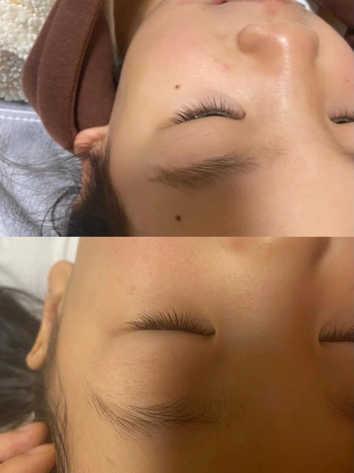 痣不代表个性 清晰无瑕的脸庞 才是我选择