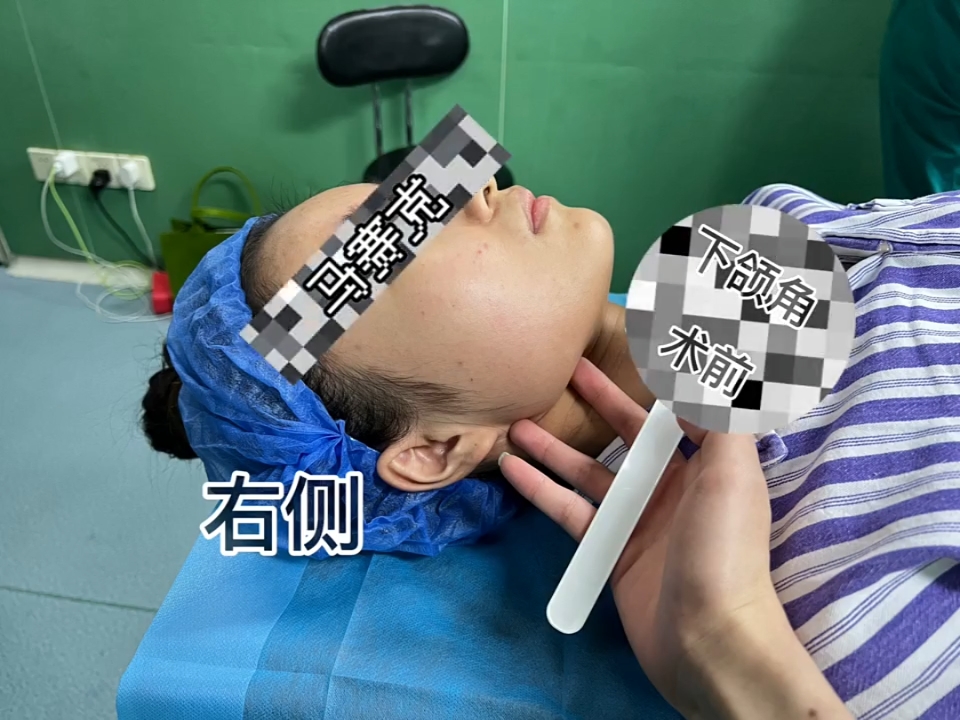 下颌角磨骨 // 面部轮廓是地基 眉眼鼻 配图2