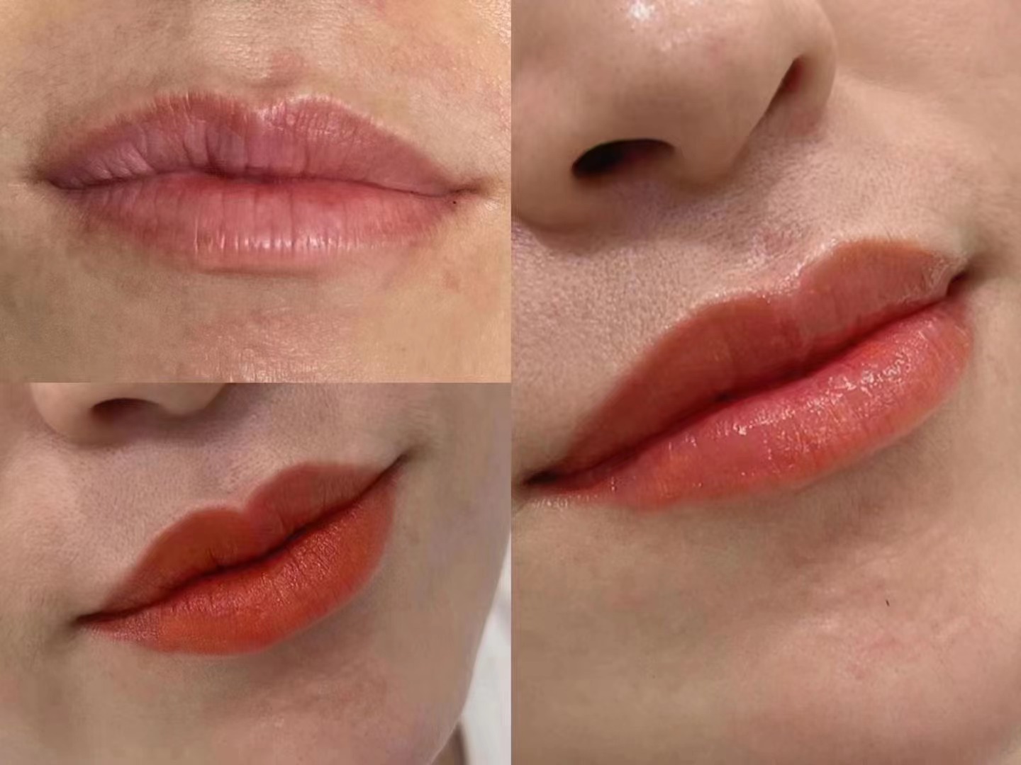 一定要把唇做了💋 无痛恢复快恢复后呈自然