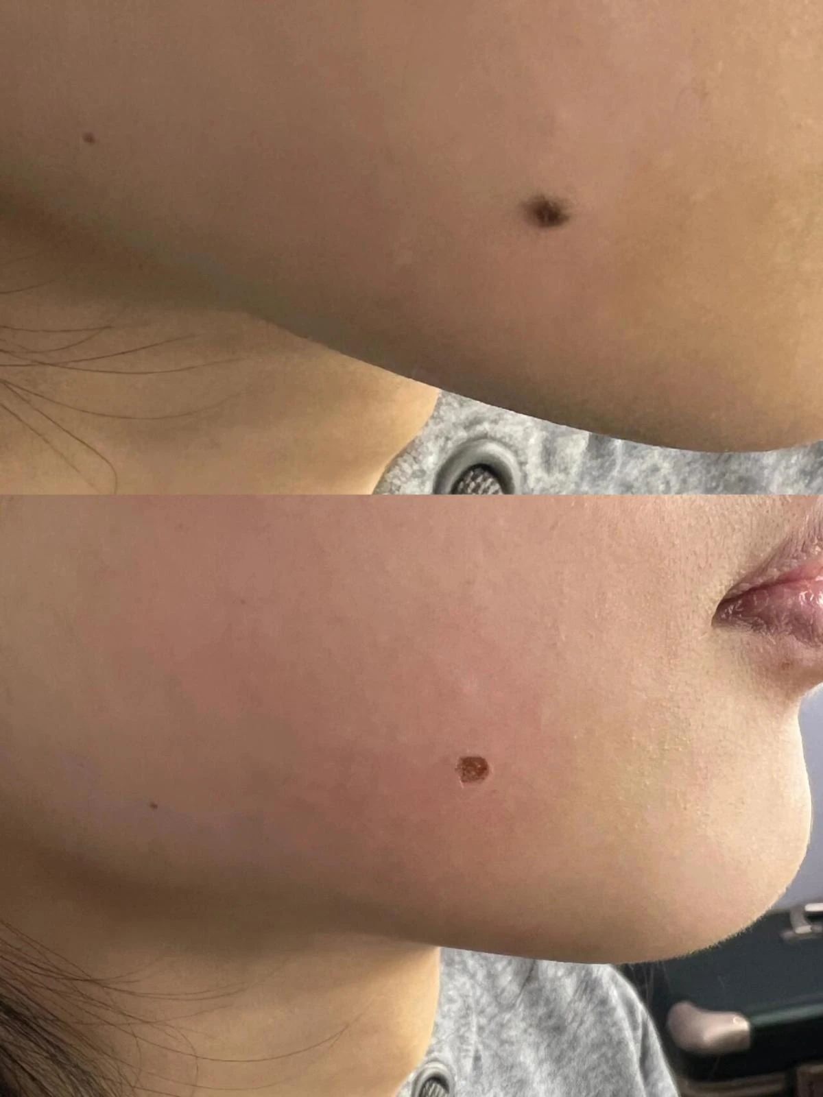 痣，虽小却不容忽视 它们承载着健康的秘密
