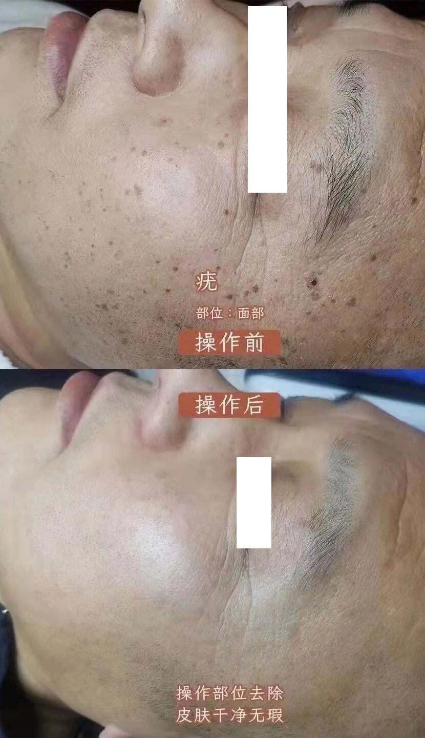 跟扁平疣说再见 让美丽不再打折！ 激光技