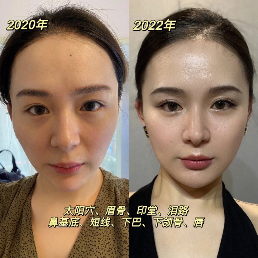 客户做了一年的抗衰 通过微调的方式改善自