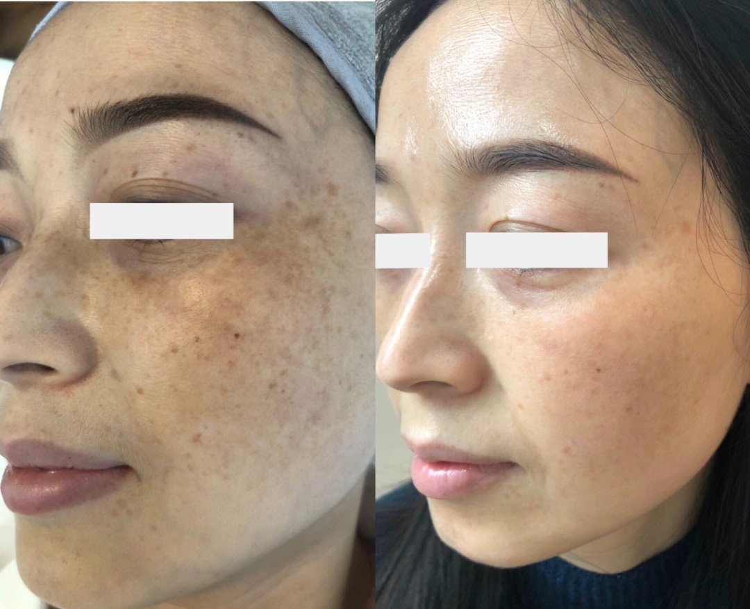 都说“一白遮百丑，一斑毁所有” 斑点和痘