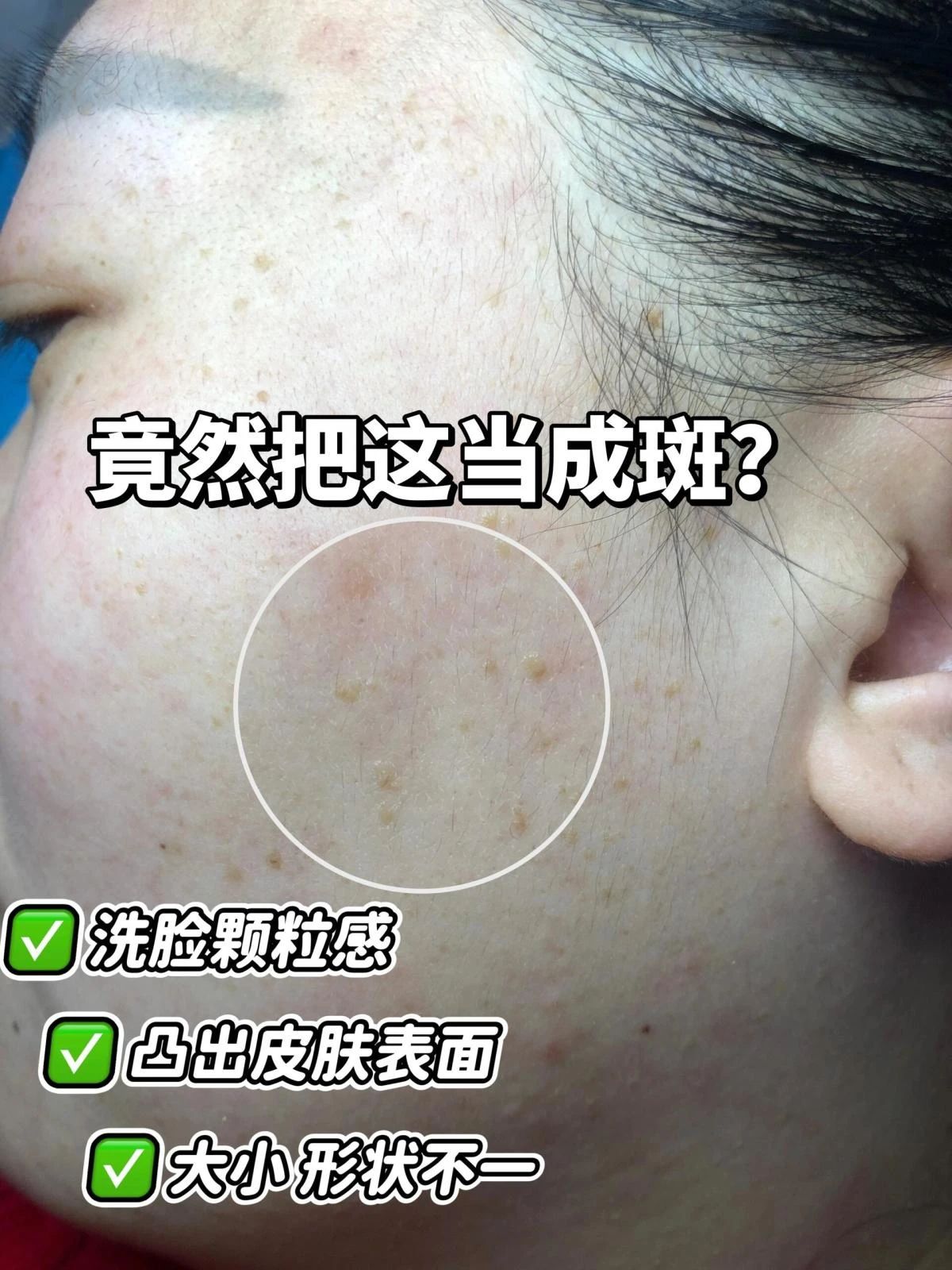 扁平疣常在机体免疫力降低时出现 🔊有一半