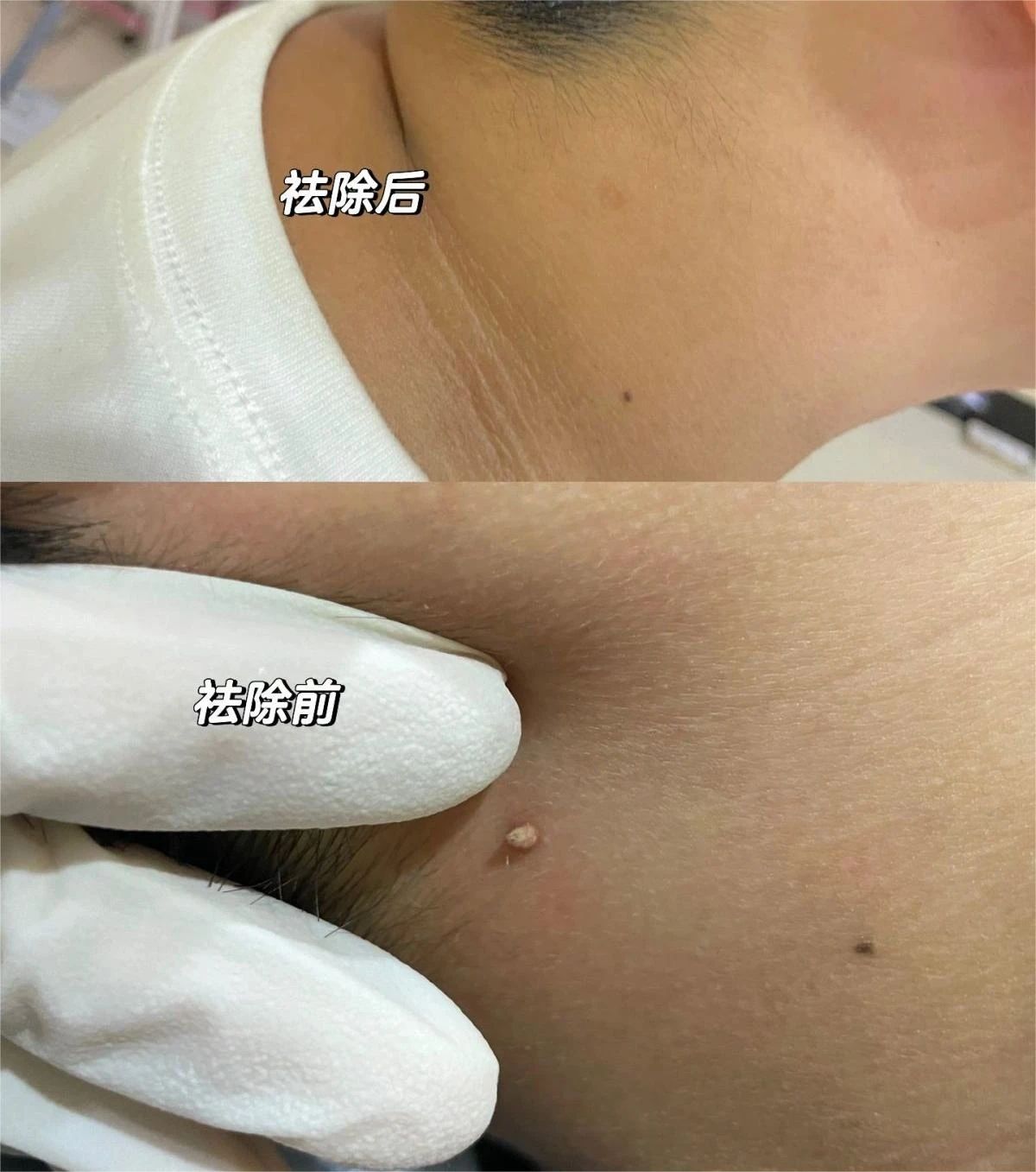 刺瘊也是一种疣，寻常疣 表面坚硬、干燥，