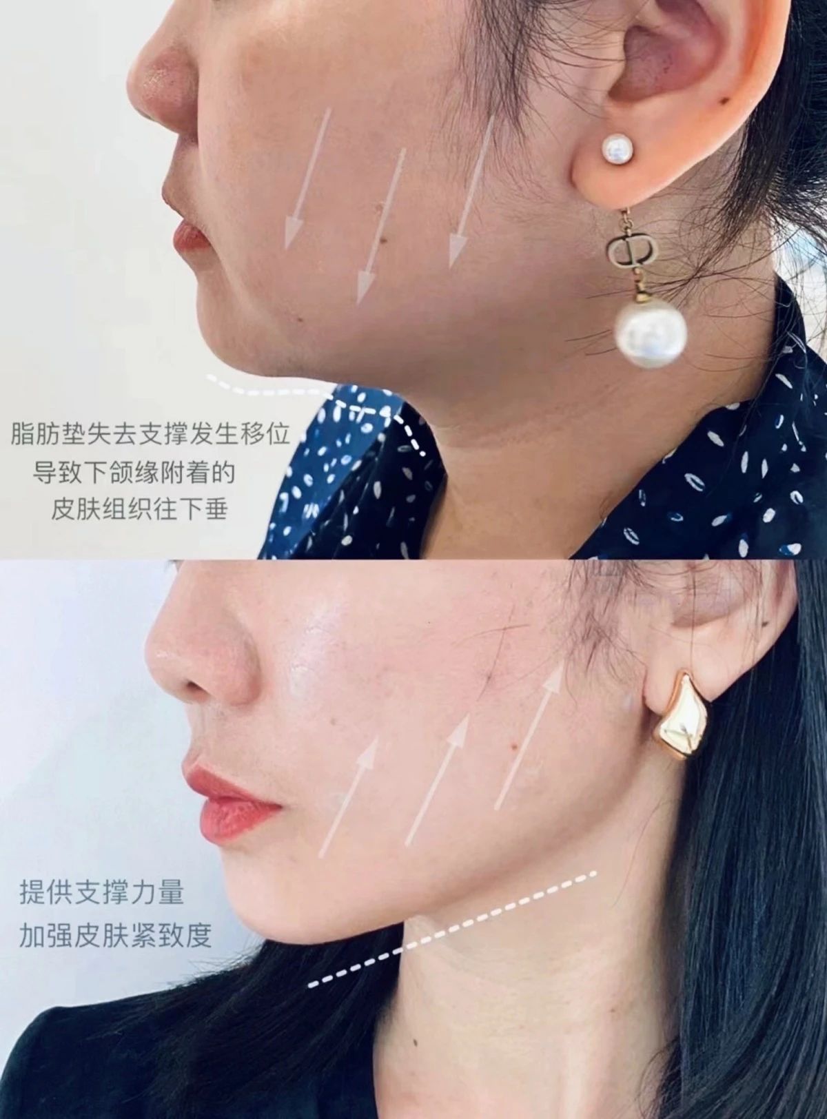 下颌线提升🆚 有些罪，遭一下也没啥 毕竟