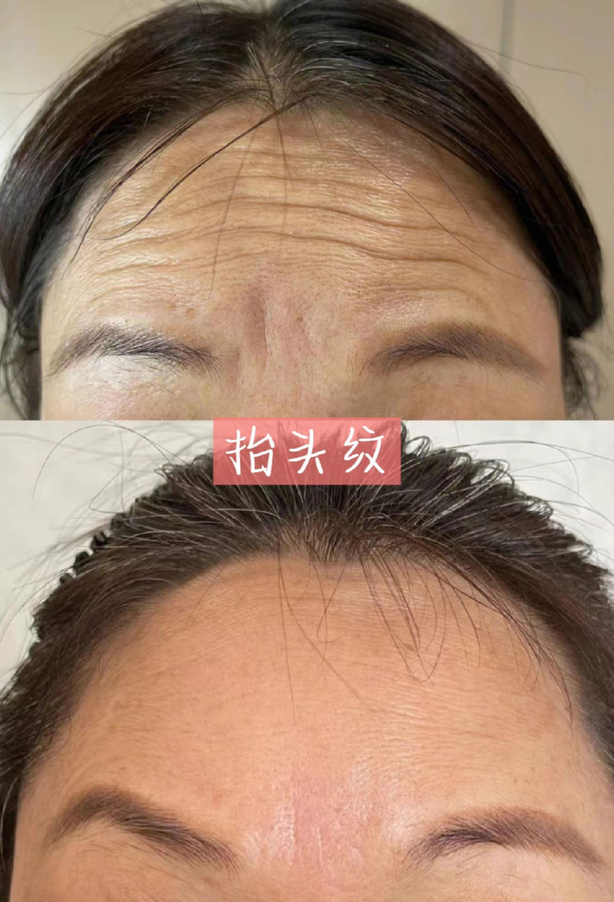 年纪越来越大，皱纹也越来越深 动一下就牵