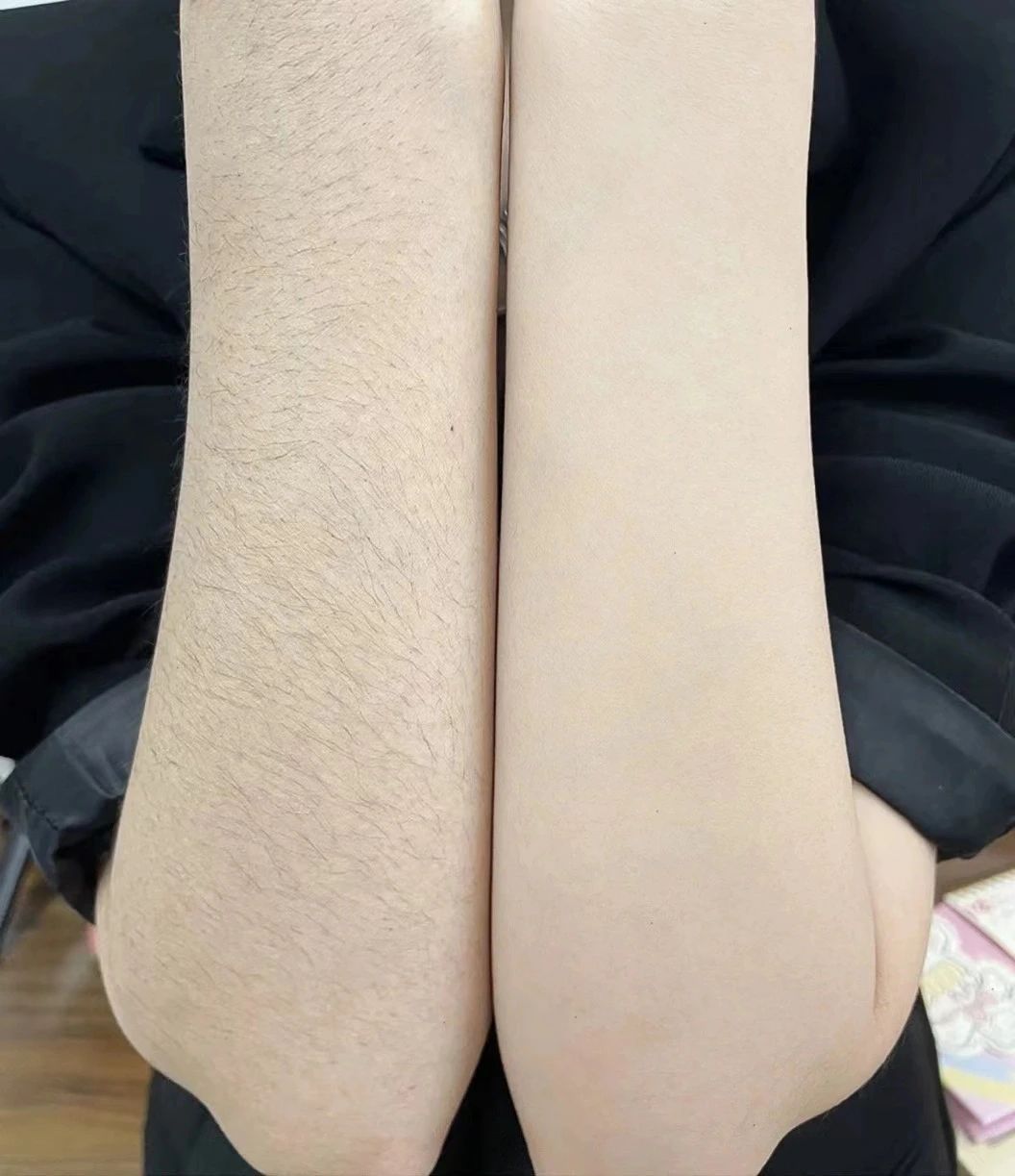 春季脱毛💦 脱掉尴尬，脱掉烦恼 你的美丽