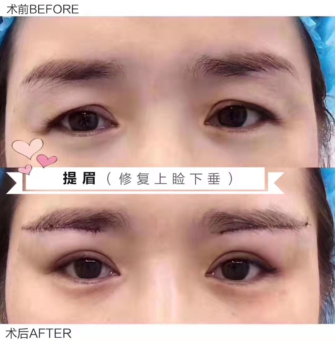 ✍️提眉术 脸那么美，被眼皮下垂拖后腿。