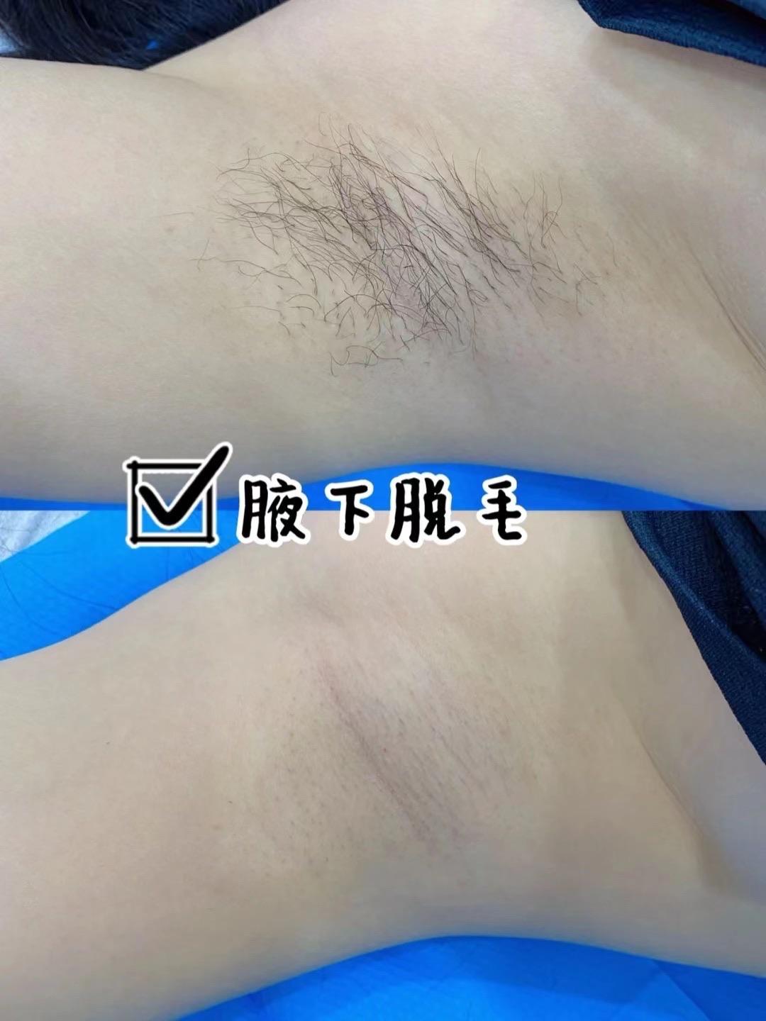 腋下冰点脱毛 好干净