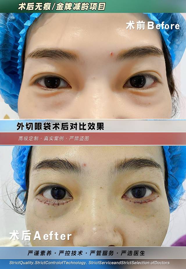 祛眼袋 眼袋越早祛除越好 因为眼袋一旦长