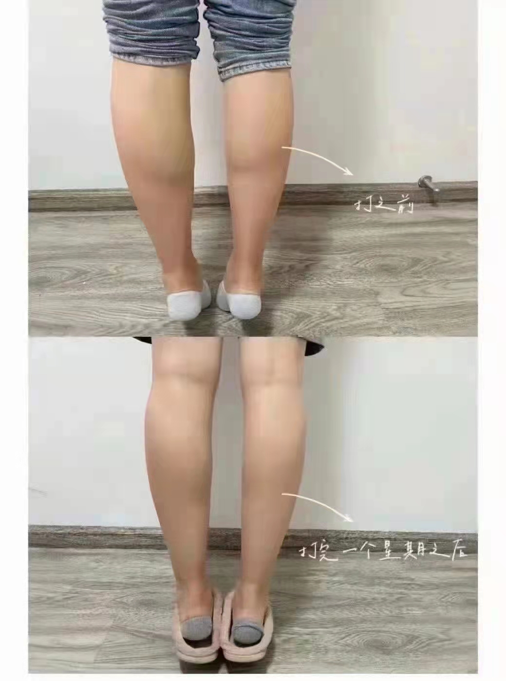 瘦腿针，没什么牛的 也就是能让你看起来瘦