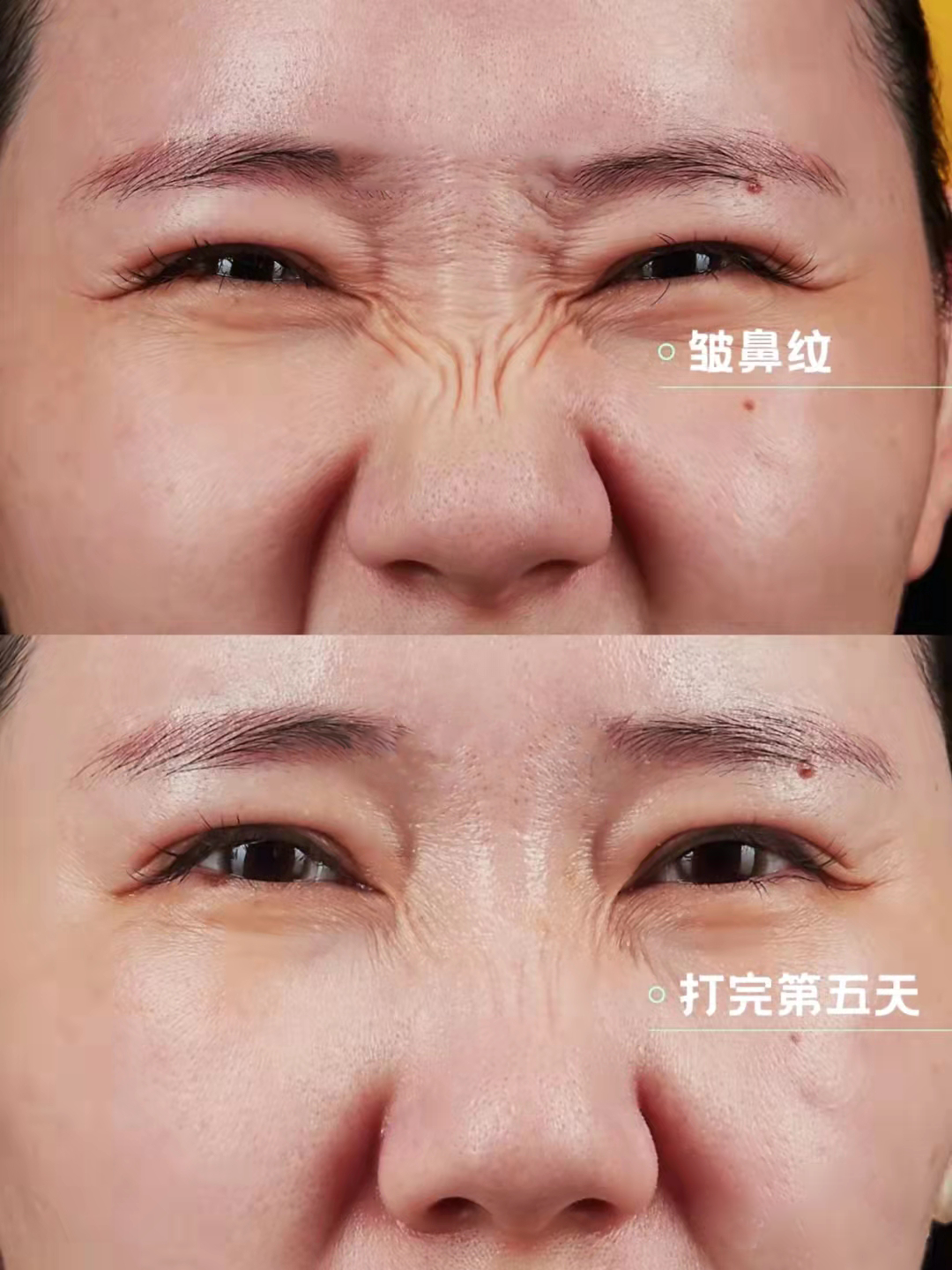 肉毒素面部除皱🆚 请大大方方的做除皱 因