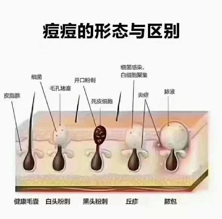 痘痘肌为什么要少吃甜食 切记⚠️控糖，清