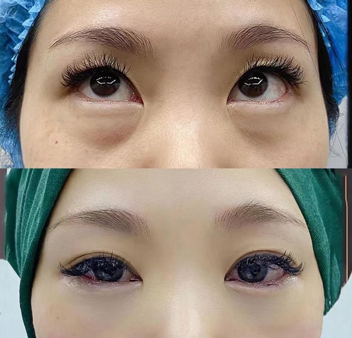 祛眼袋对比 年不年轻先看眼睛 最容易出卖