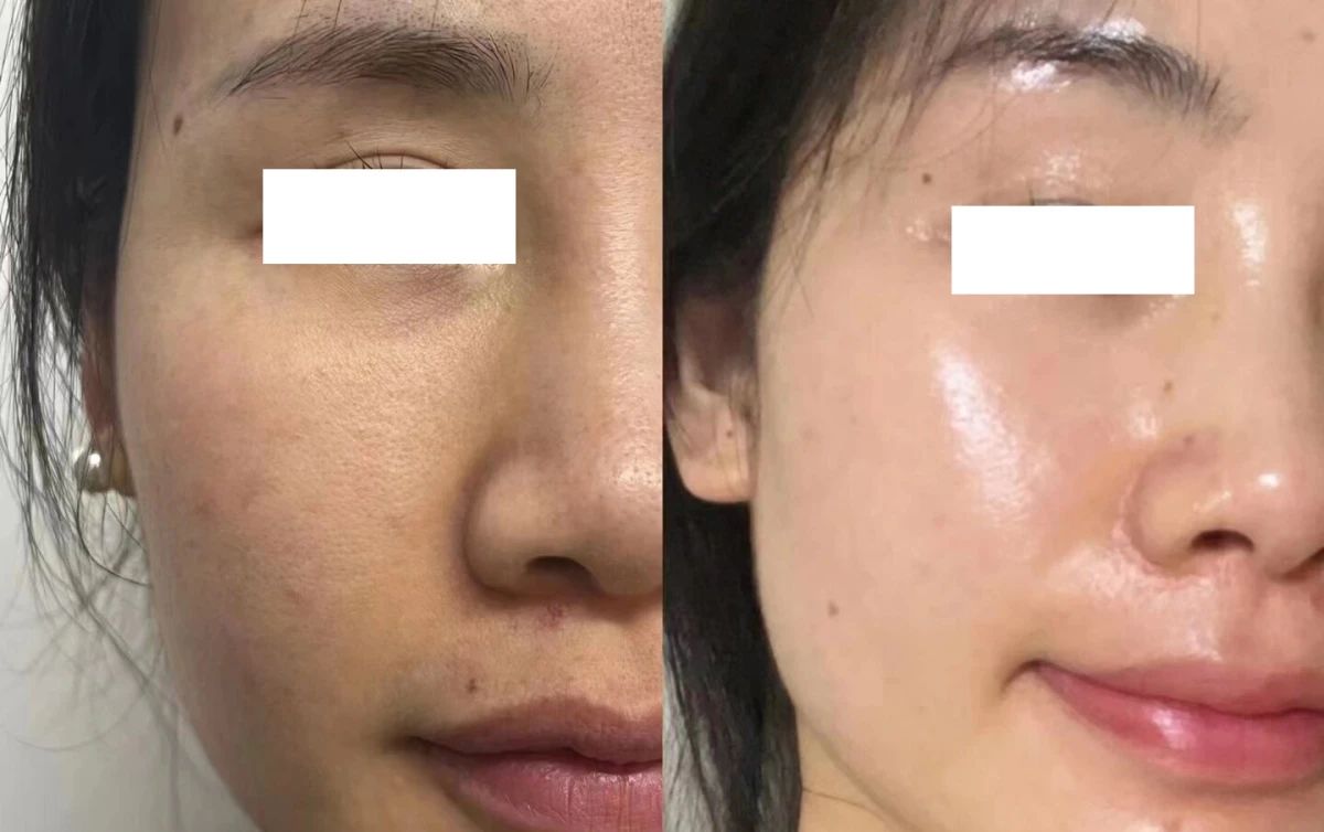 水光针护理💉 不是整形而是保养 给自己打