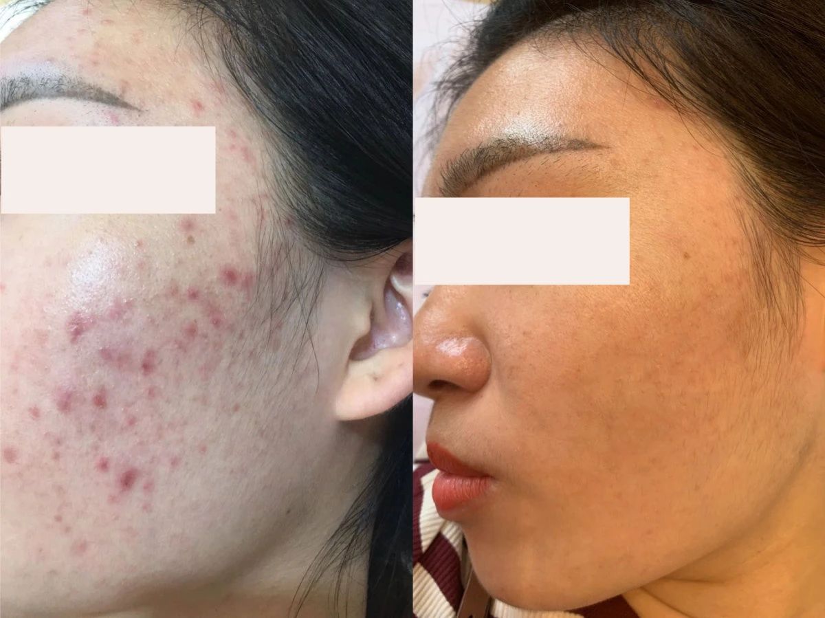 痘痘从来不是“拖”好的 而是专痘专治，科