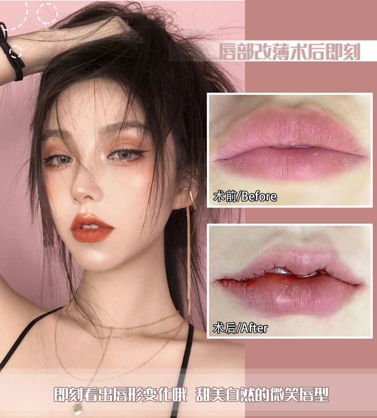 术后改薄术后案例对比 即刻看出唇形变化哦