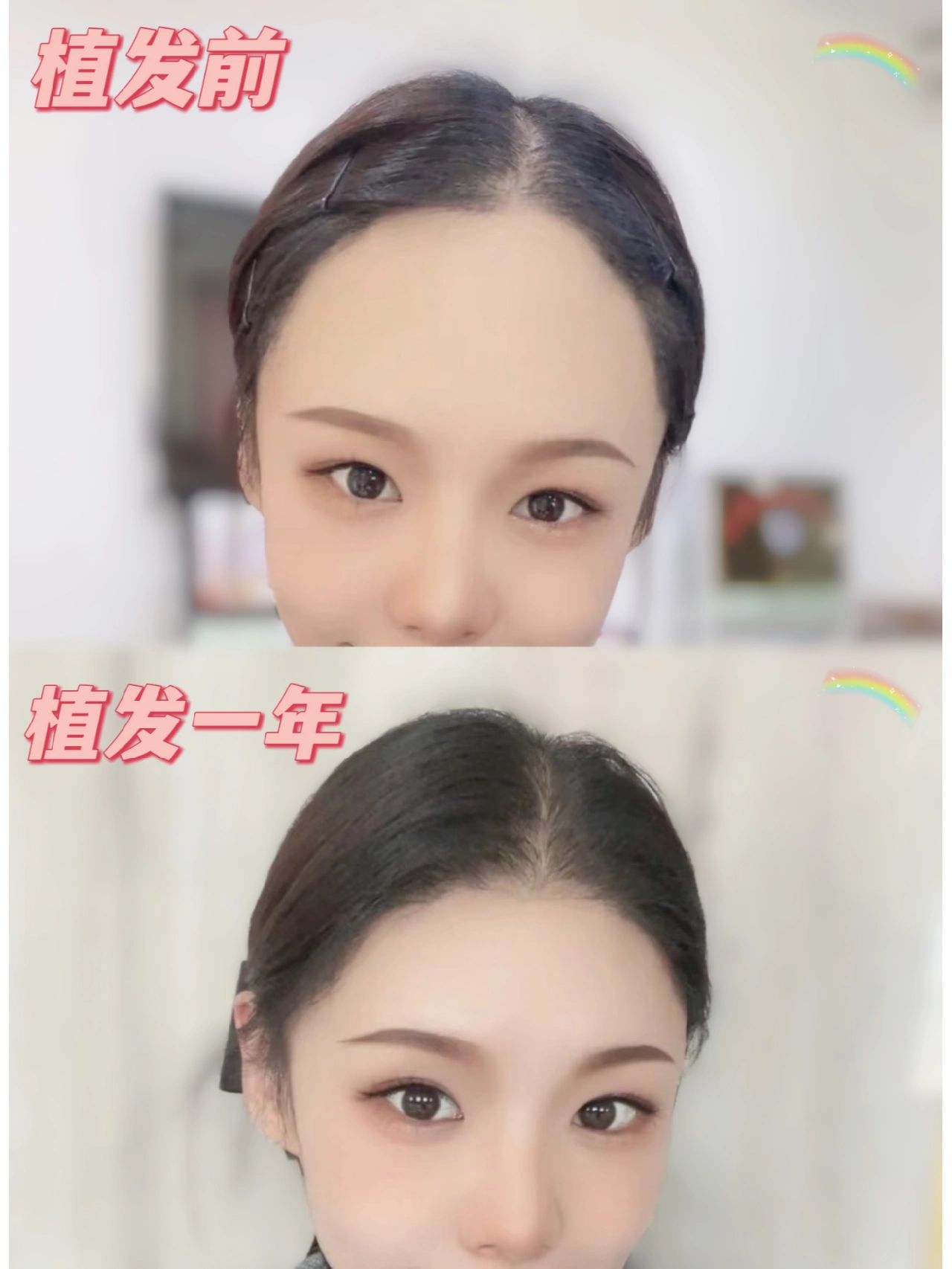 植发一年，胜过美颜！