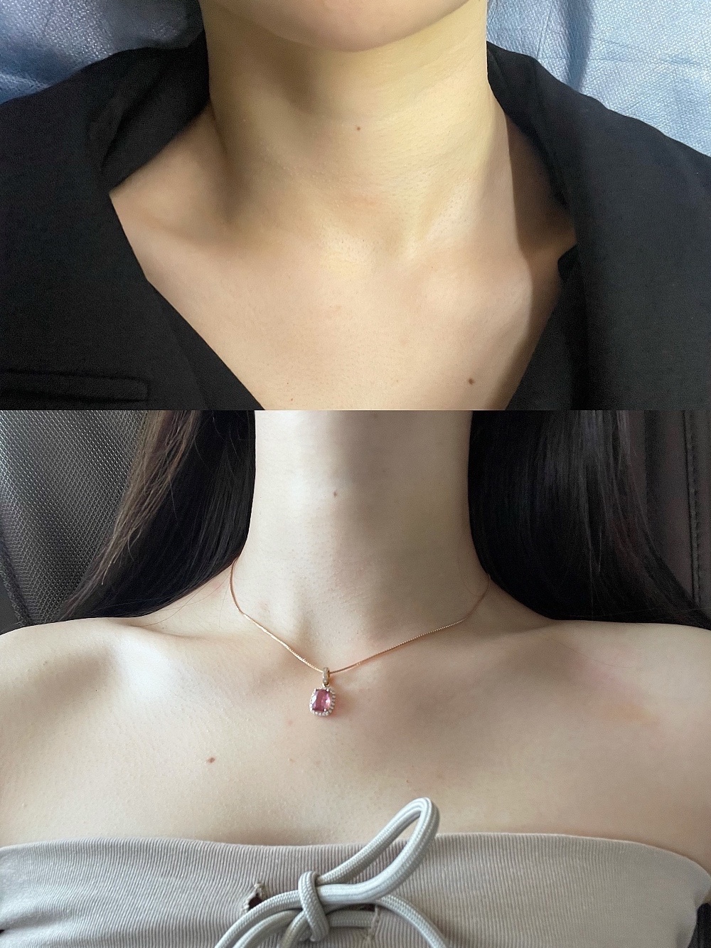 嗨体祛颈纹💉 拒绝脖子一圈两圈三圈 别让