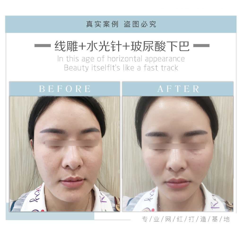 线雕+水光针+玻尿酸下巴 小姐姐做了三项