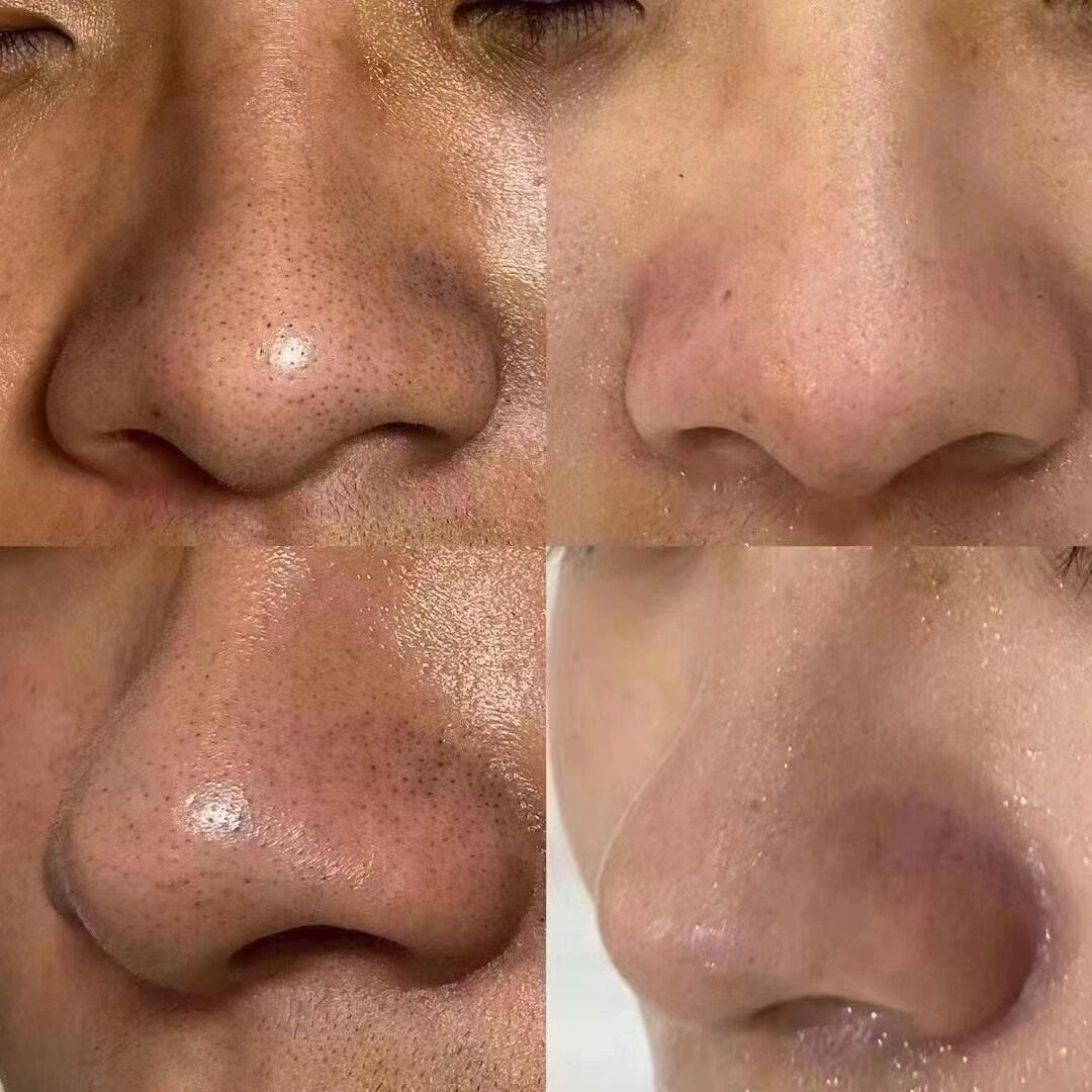清洁毛孔比拼命护肤更重要 一次好的皮肤管