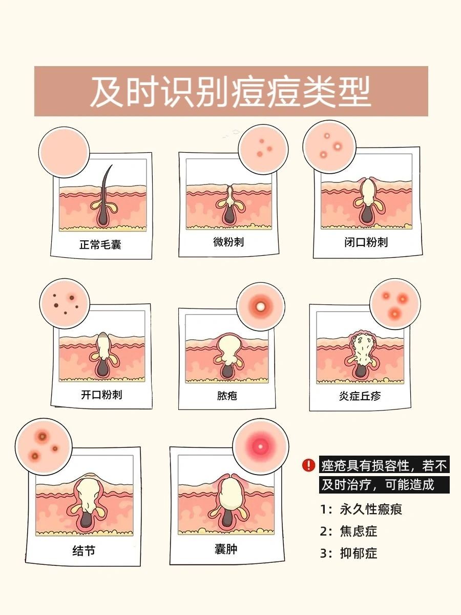消灭痘痘要先了解它 及时识别痘痘类型 针